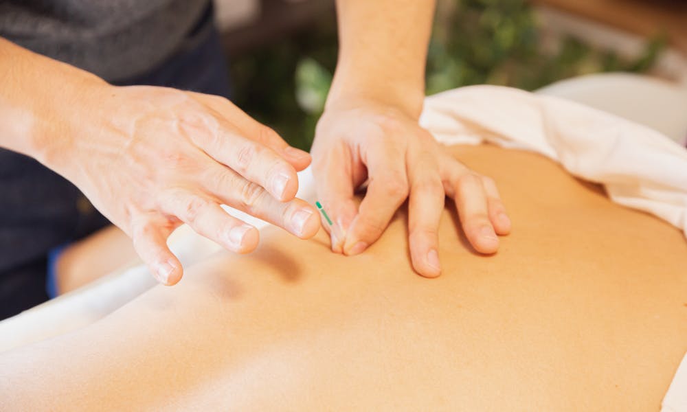 From above of crop anonymous man applying needles on back of client during acupuncture procedure .pexels