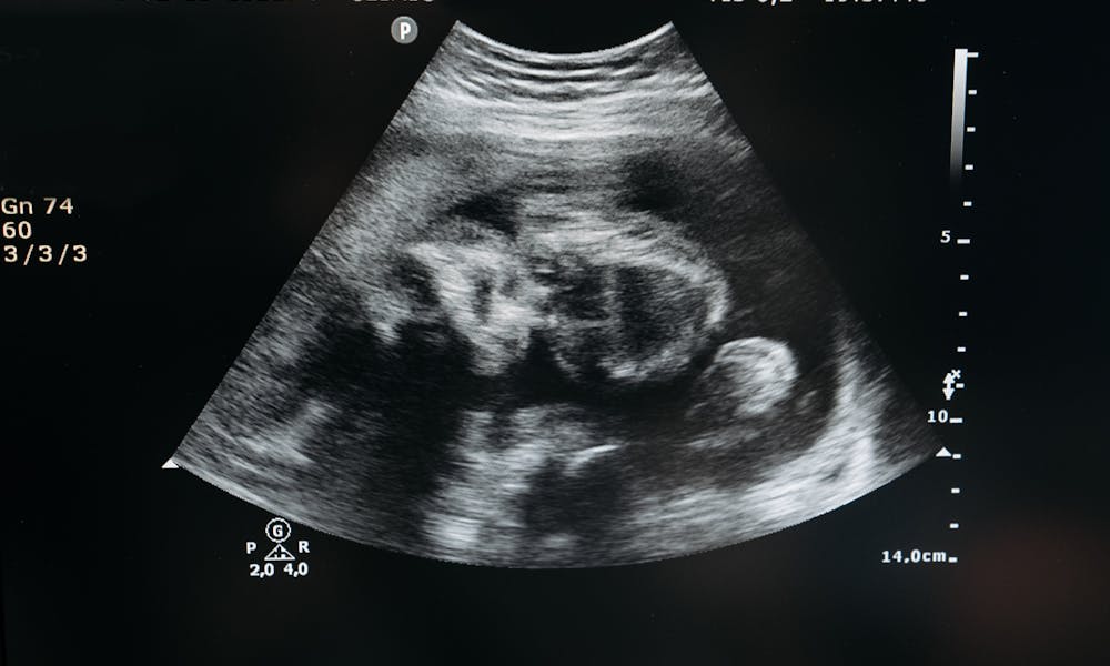 Ultrasound scan showing the image of an unborn child in the womb, highlighting pregnancy and healthcare. .pexels